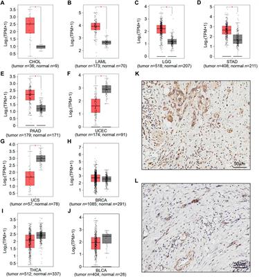 High expression of RNF169 is associated with poor prognosis in pancreatic adenocarcinoma by regulating tumour immune infiltration